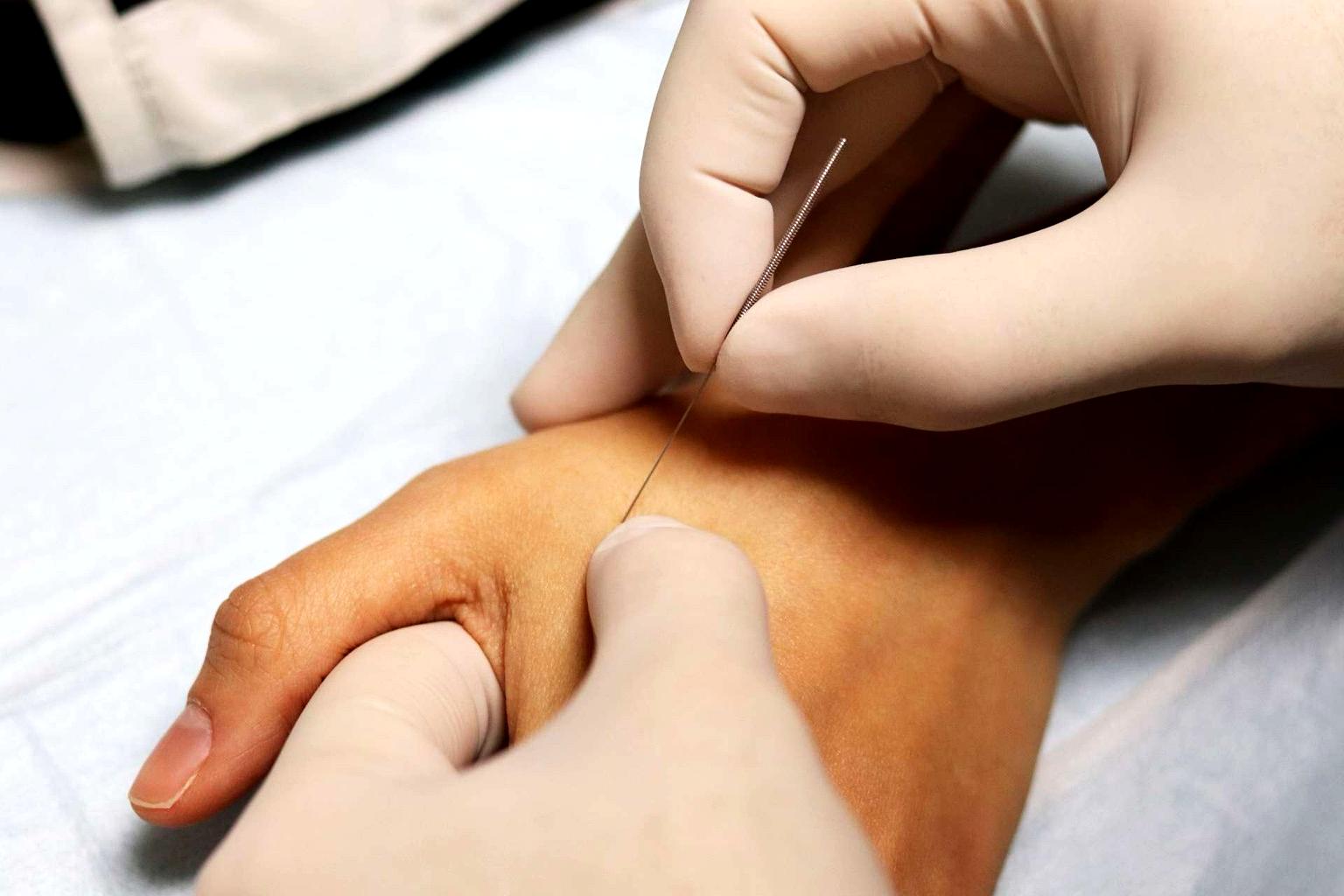 CallinWood_PT_dry_needling_2_enhanced